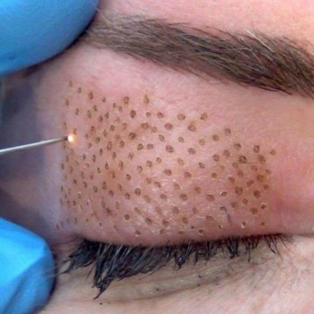 Jato de Plasma at Jessica Luchesi Skin Wellness in Elizabeth, NJ