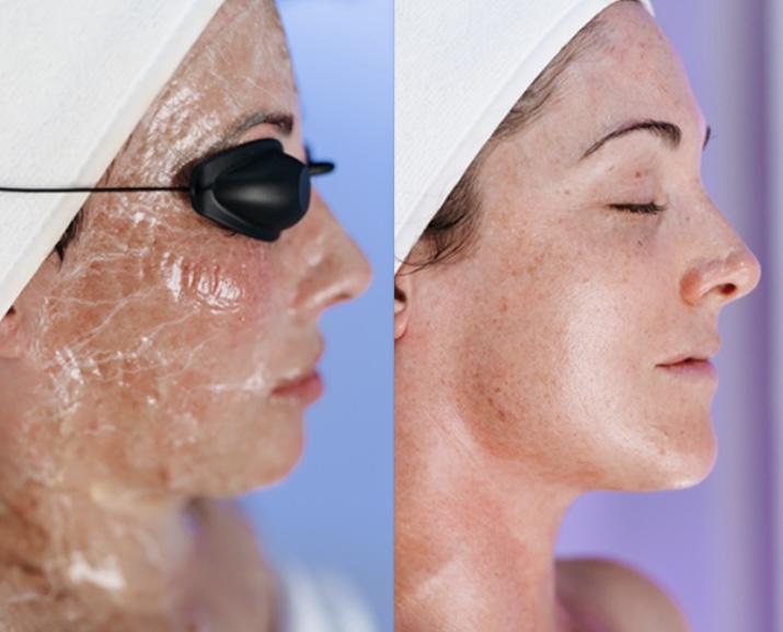OCTOBER SPECIAL Zombie Facial