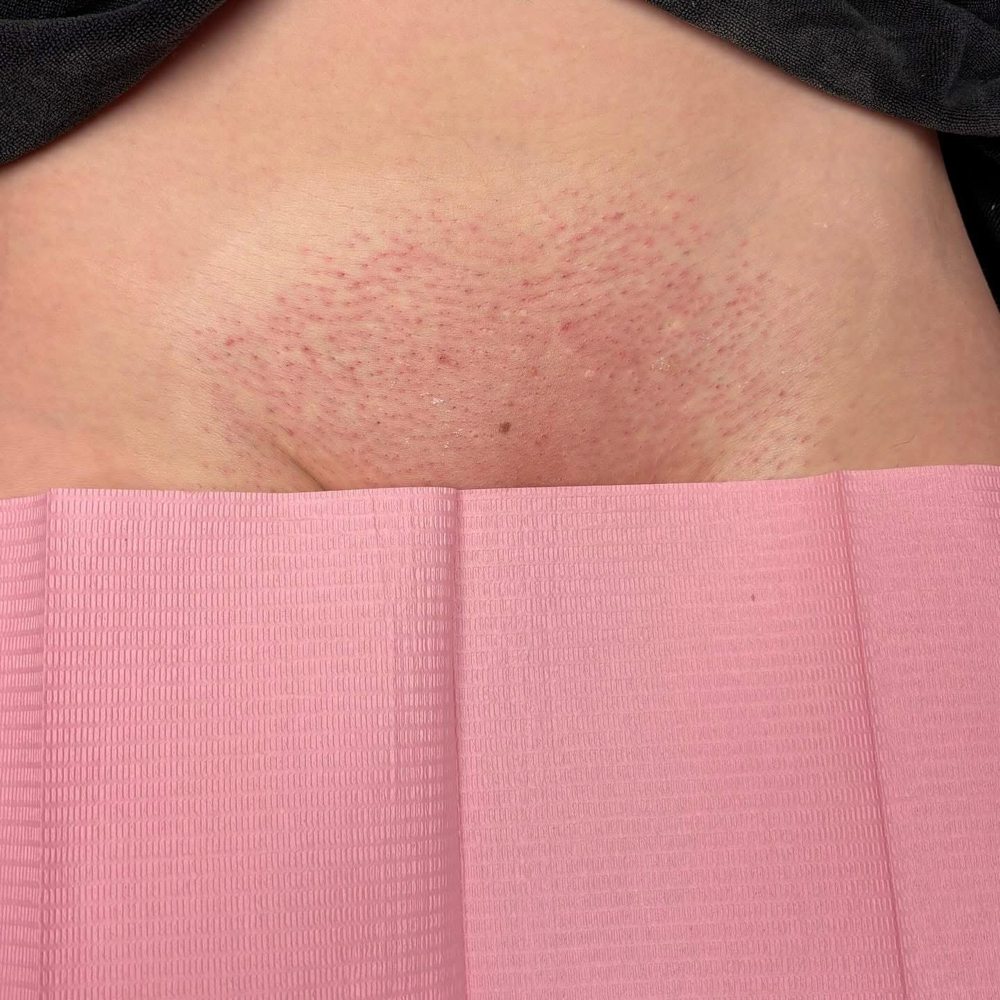Brazilian Wax