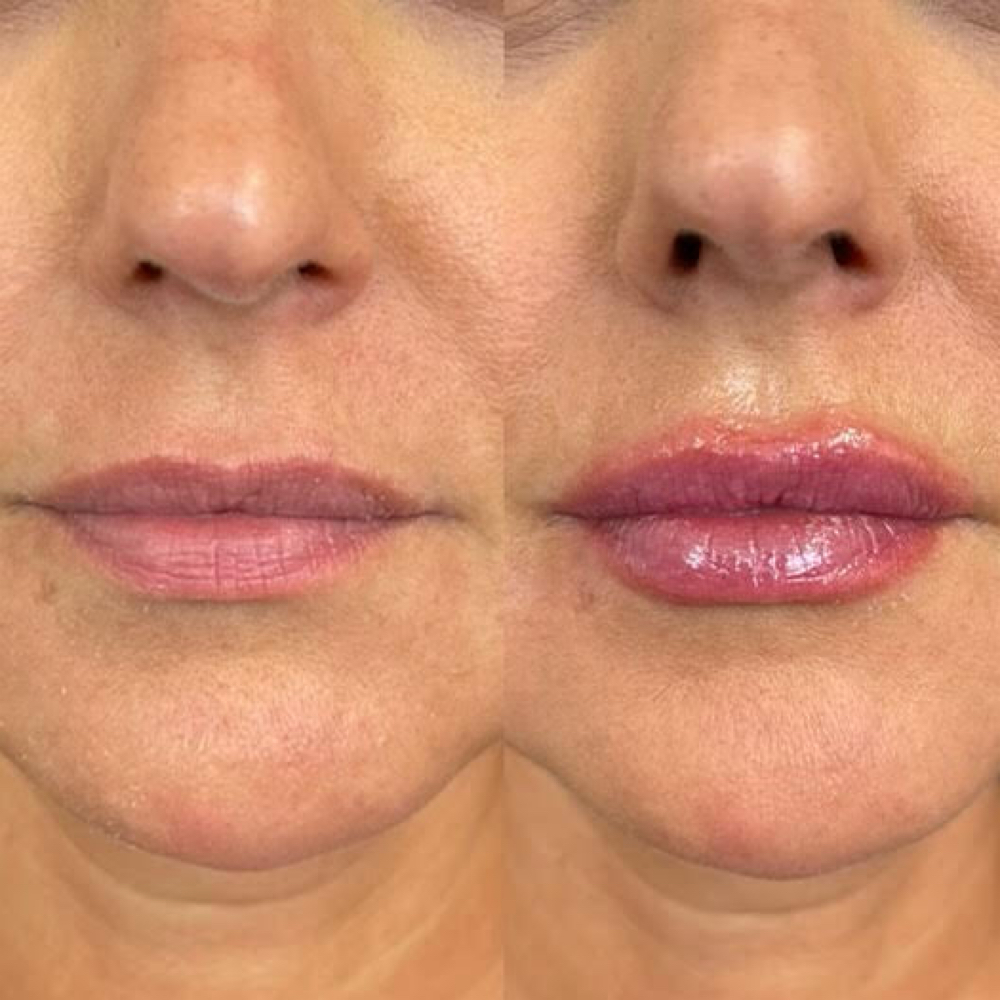 Fotona LipLase – Rejuvenecimiento at Visage Med Spa in Phoenix, AZ