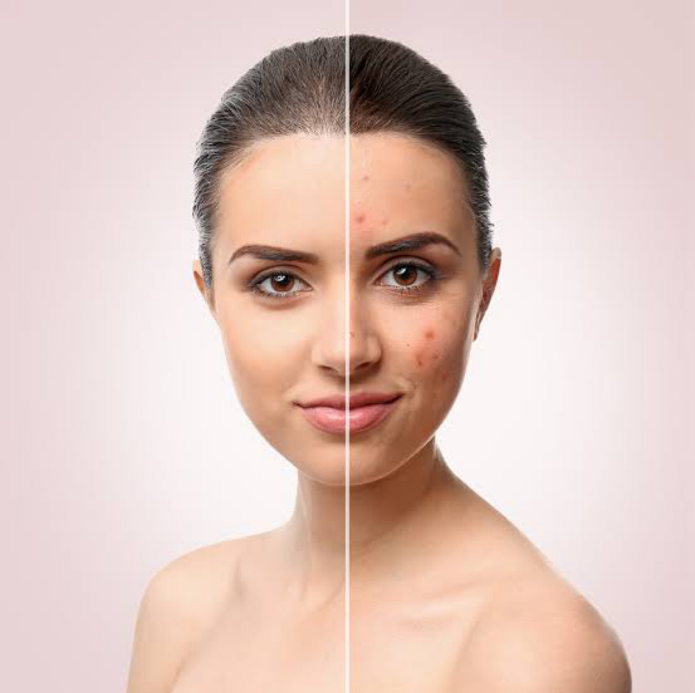 Acne &  Blemish Care Facial at One & Only Esthetics in Kansas City, MO