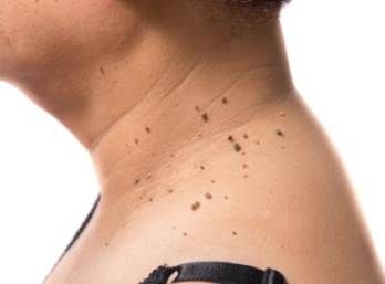 Skin Tags & Mole