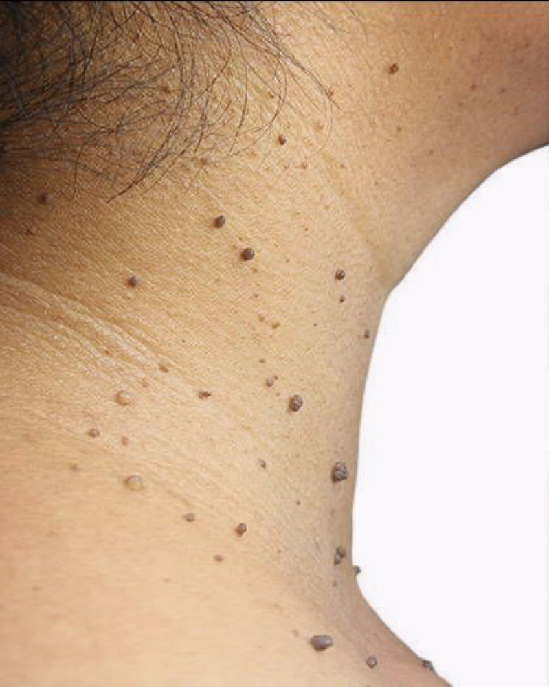 💥Skin Tags & Mole