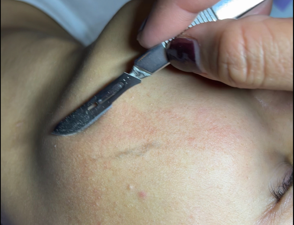 Dermaplaning Facial