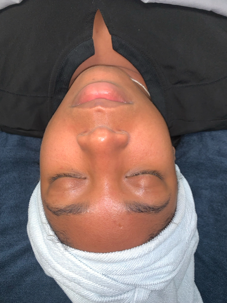 Facial Chemical Peel