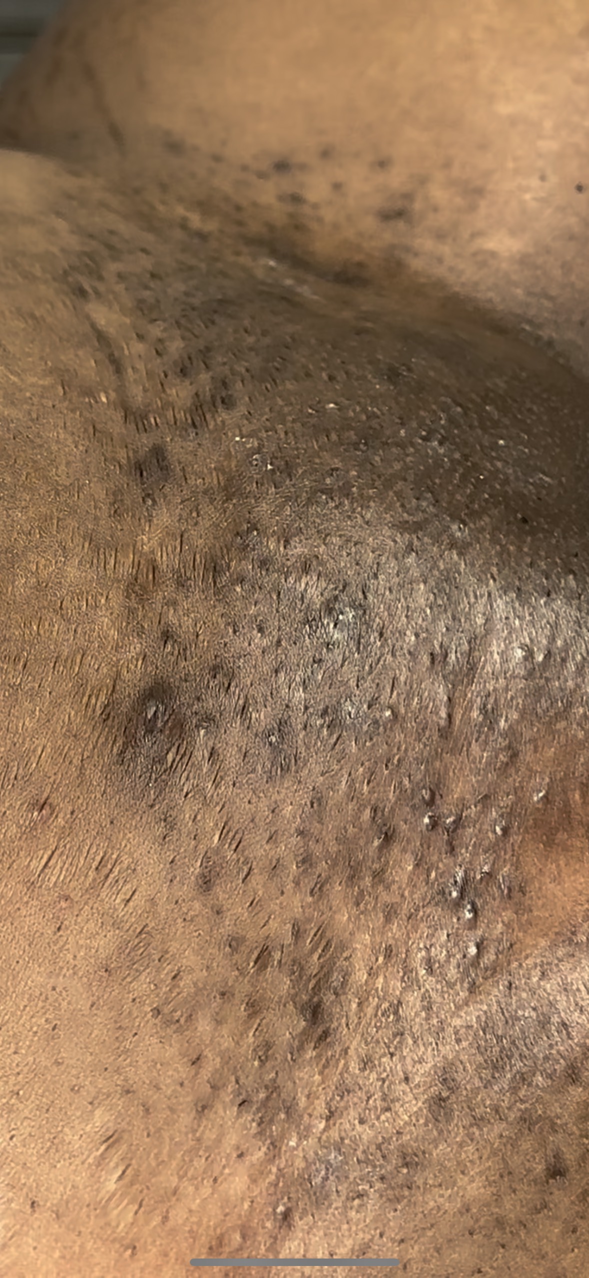 Ingrown Treatment