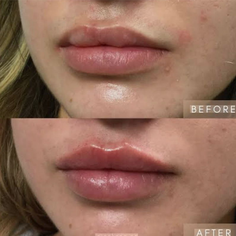 DermaFiller-Lips/Cheeks/Nasal Folds at Glo'Up Body Spa in Atlanta, GA