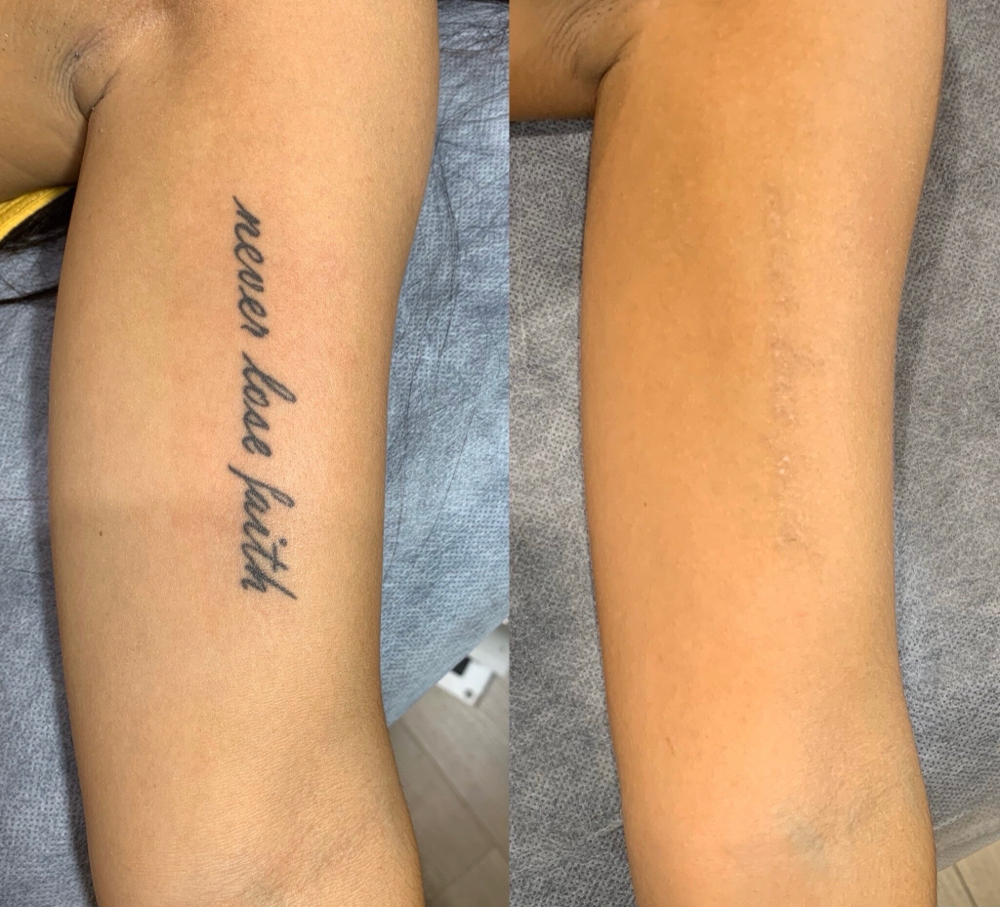 Tattoo Removal