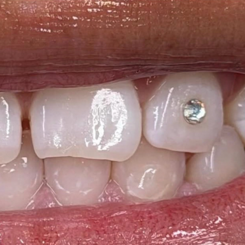 Tooth Gem Application Swarvoski Gem at Icey Whites By Blondee in Lawrence, MA