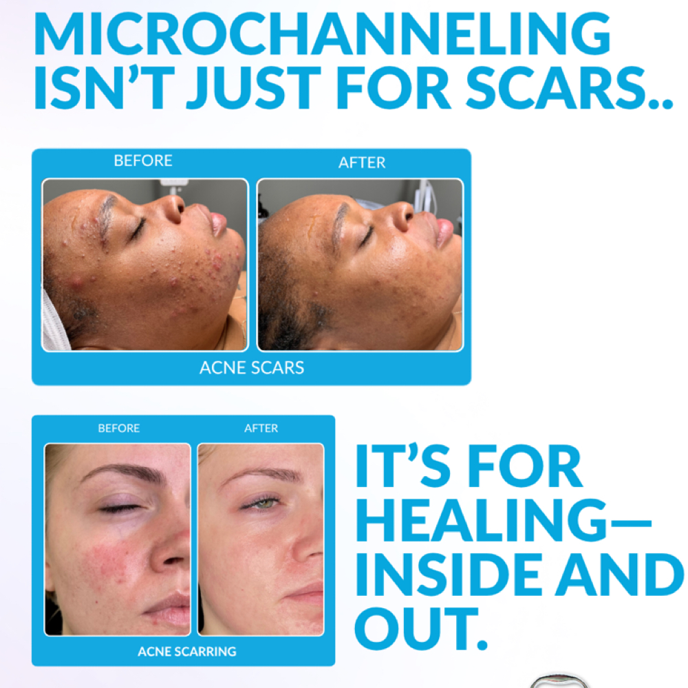 Procell Microchanneling at Iris Aesthetics Studio in Rogers, AR