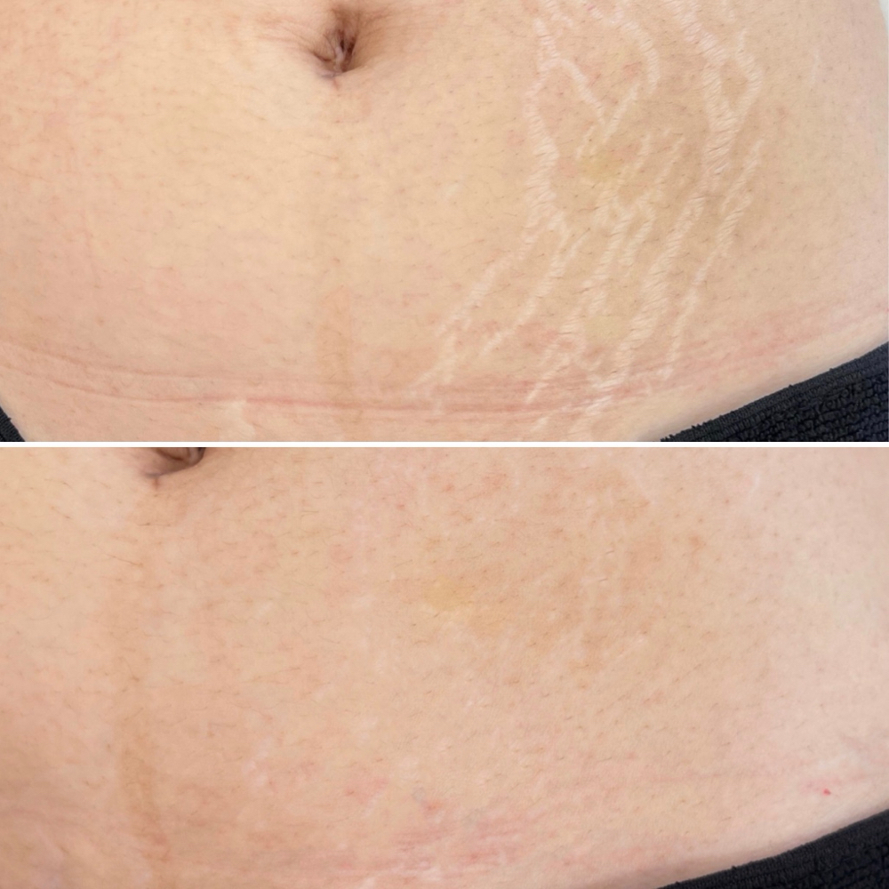 Stretch Mark Camo | Medium Area at Skin Theory Collective in Port Richey, FL