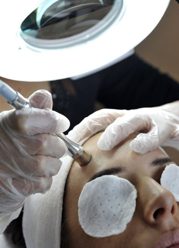 Microdermabrasion