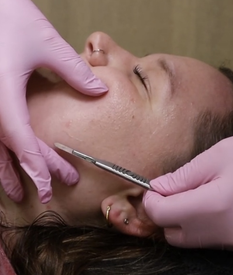 Dermaplaning Facial at Aesthetically Tatum in North Little Rock, AR