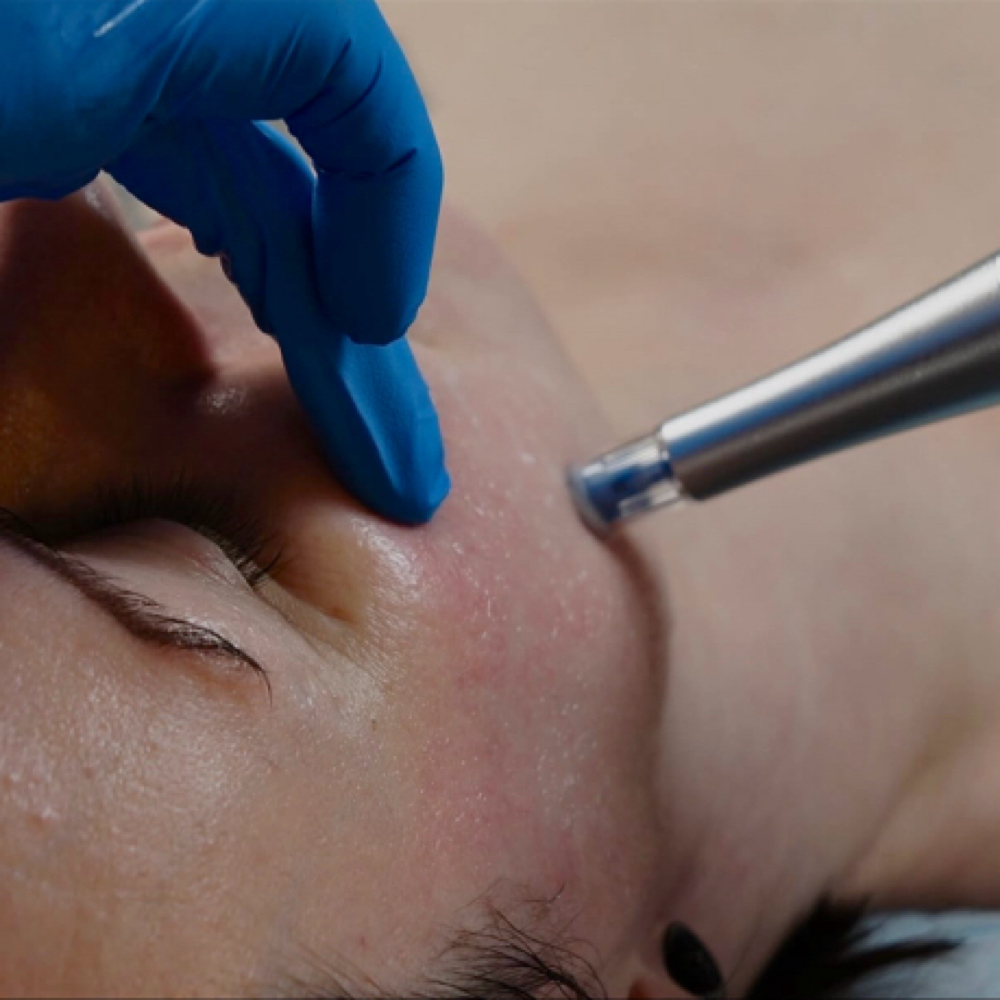 Nano Infusion Add-On (ReZenerate) at Salt + Light Skincare in Atascocita, TX