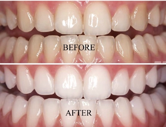 Teeth Whitening