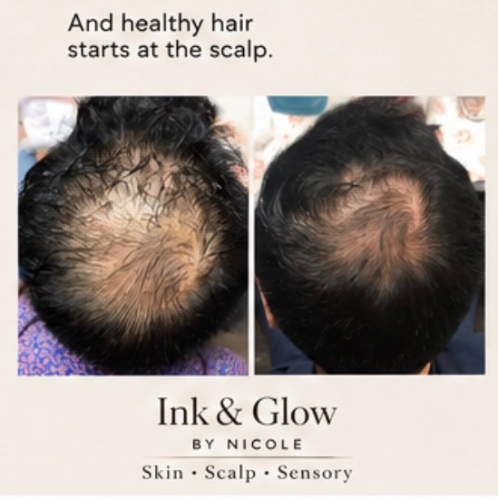 Breeze Hair Regrowth Treatment at Ink and Glow by Nicole in Tariffville, CT