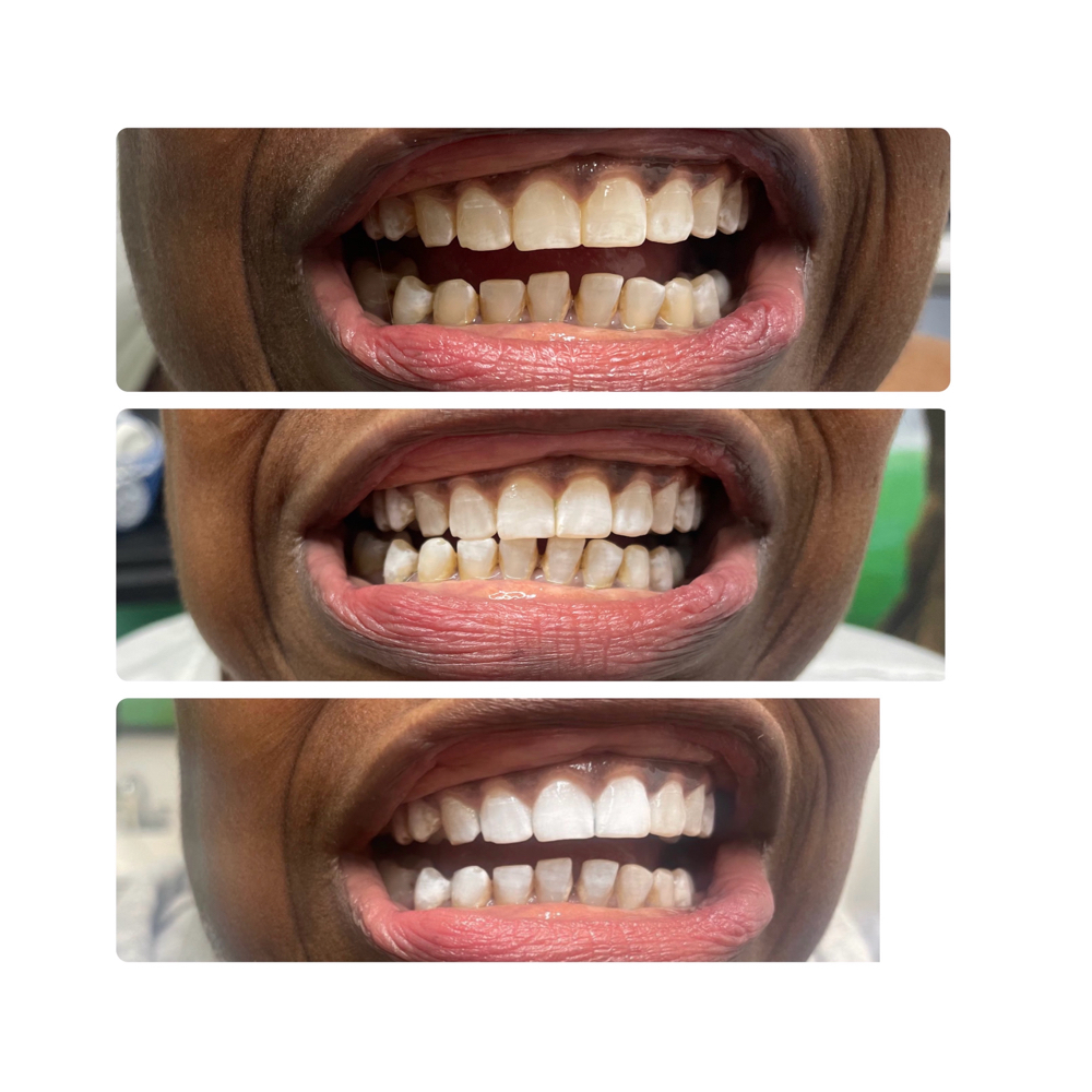 1 Treatment Of Teeth Whitening