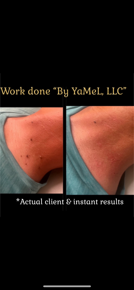 Removal of Skin Tags