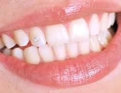 MODEL PRICE Tooth Gems