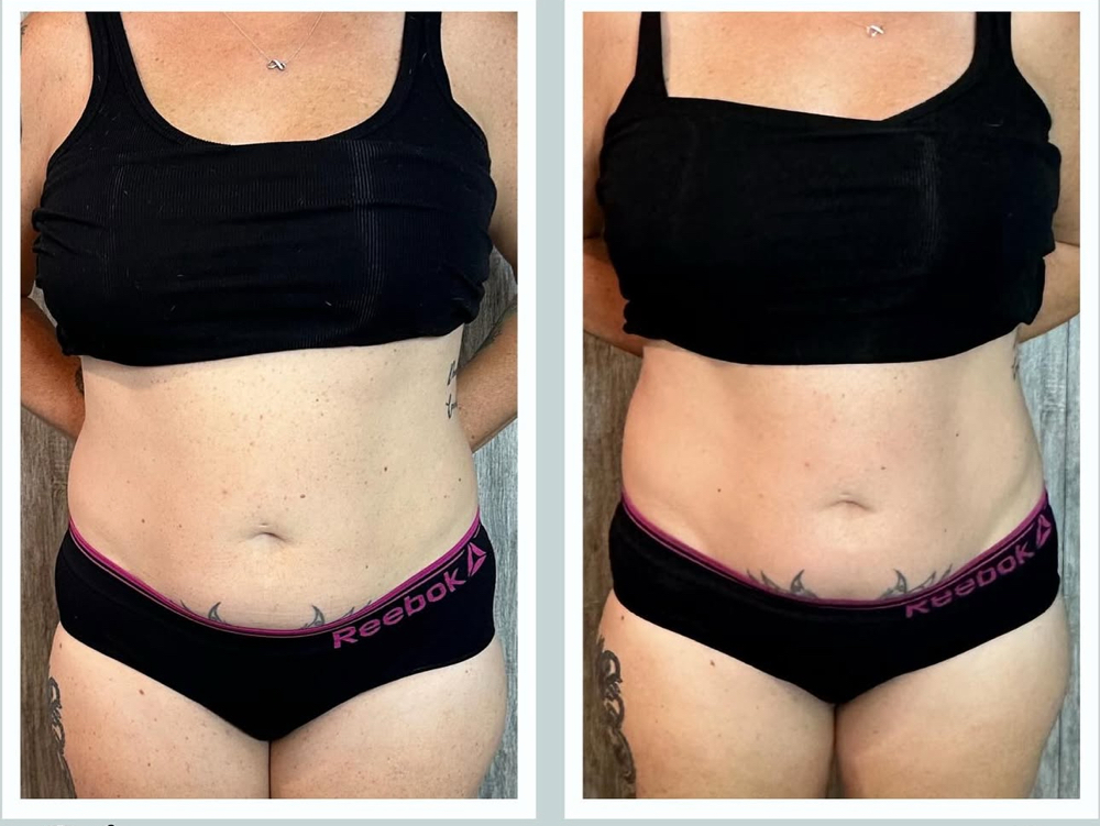 Body Contouring (wood Therapy)