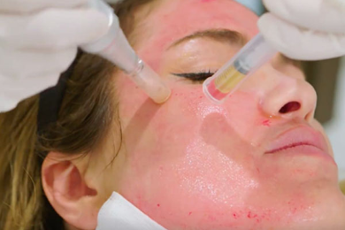 Facial Profundo+Dermapen con Plasma