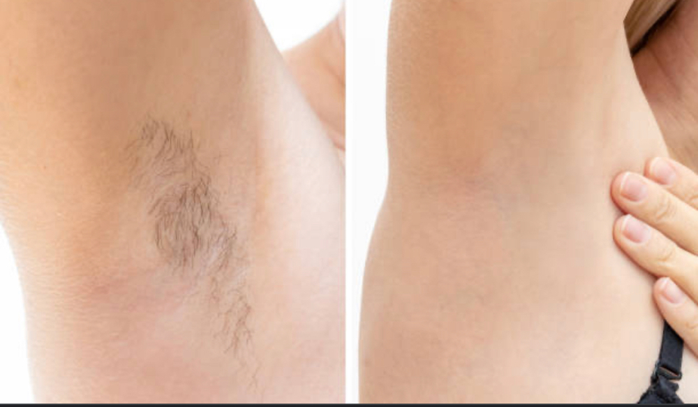 Underarms