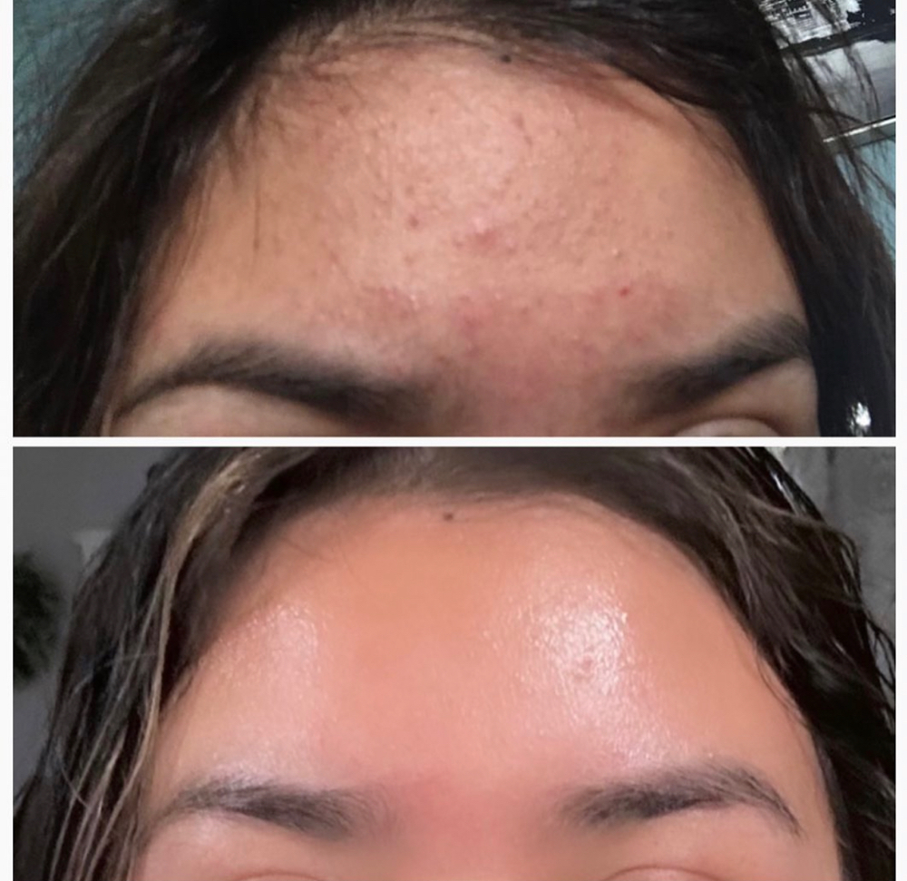 Acne Clinic