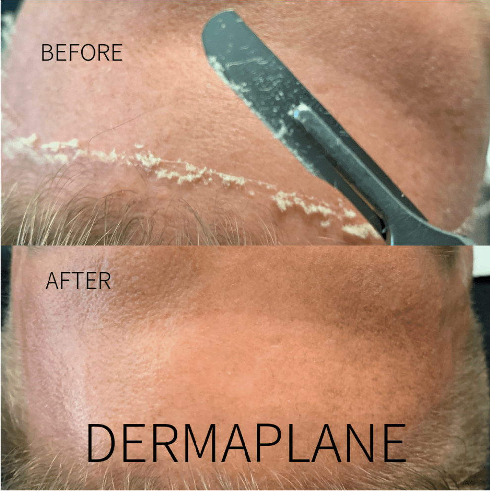 Dermaplaning