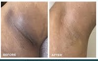 Underarm Lightining