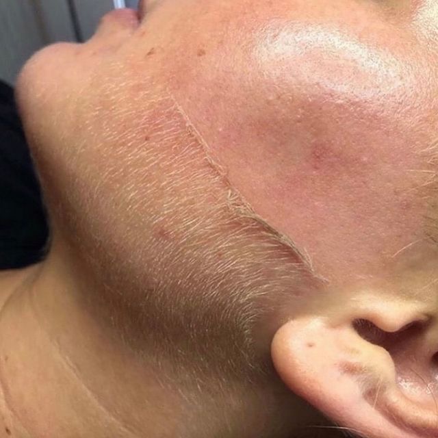 Dermaplane Facial