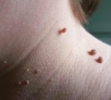 One large skin tag