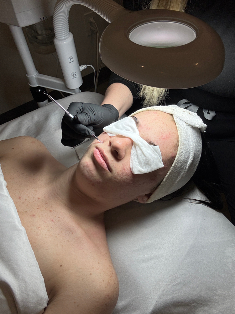 Teen Acne Facial