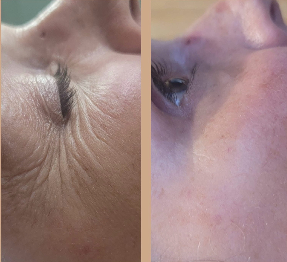 Anti-Aging Facial