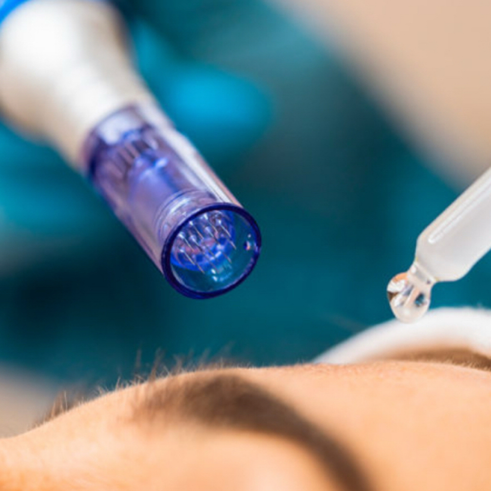 Microagulhamento ( Sessao ) at Jessica Luchesi Skin Wellness in Elizabeth, NJ