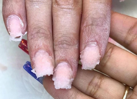 Nail Removal