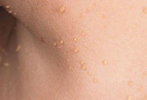 Skin Tag Removal