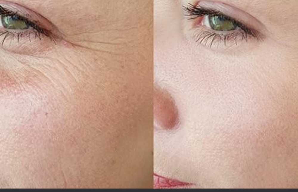 Microneedling & Radio Frequency