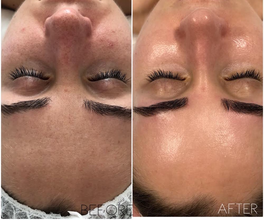Hydra-Facial With LED Light Therapy