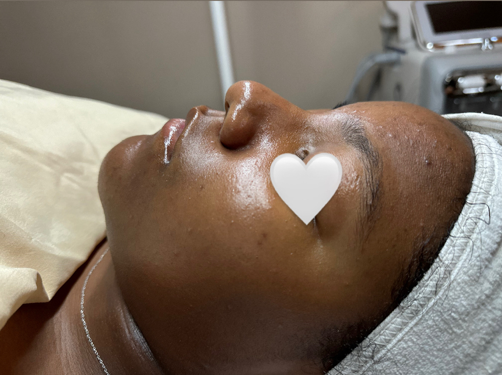 Teen Clarifying Facial (Ages 12-18) at J Esthetics in Homewood, IL