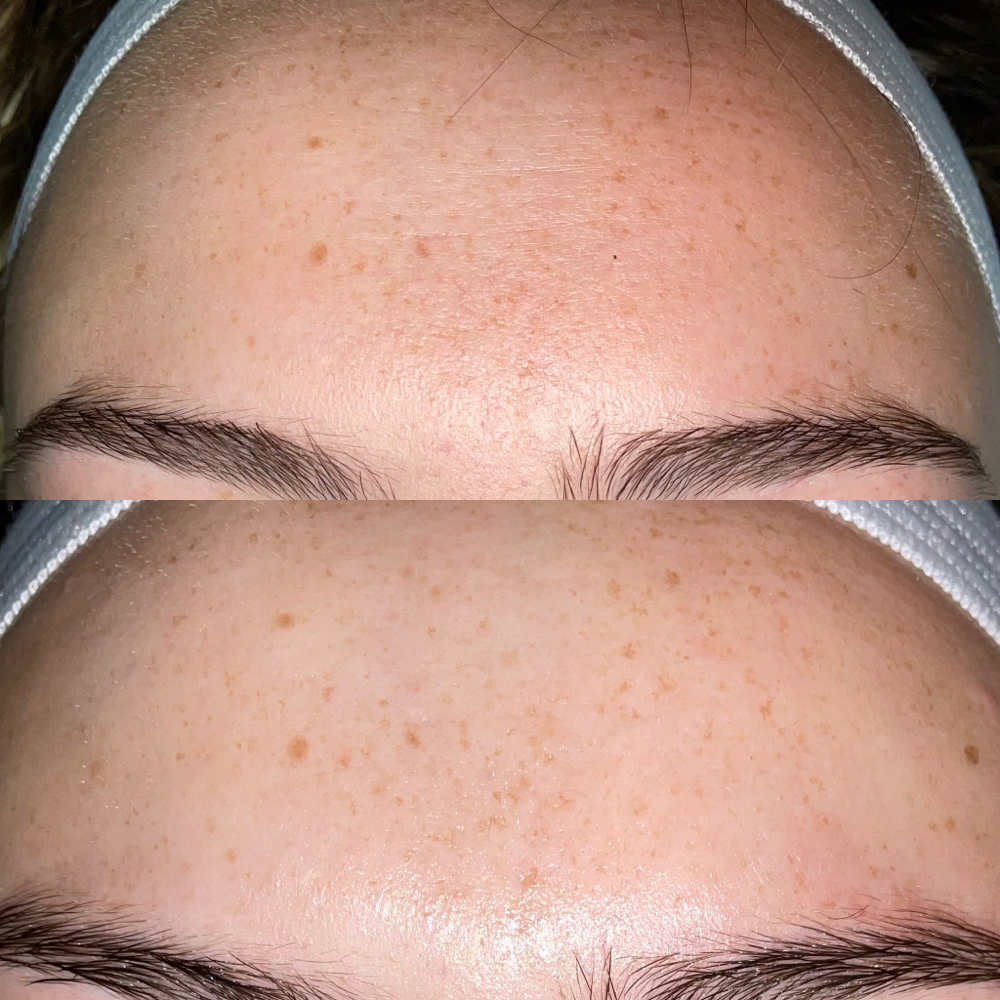 The Haus VTox Lift Facial at Haus of Lafayette Aesthetics in Winter Park, FL
