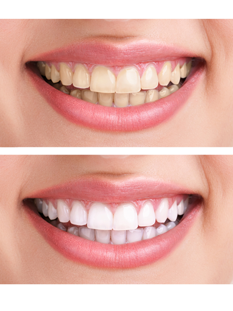 Teeth Whitening