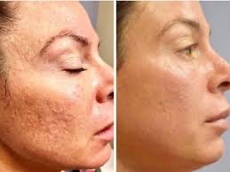 Microneedling/ Collagen Induction