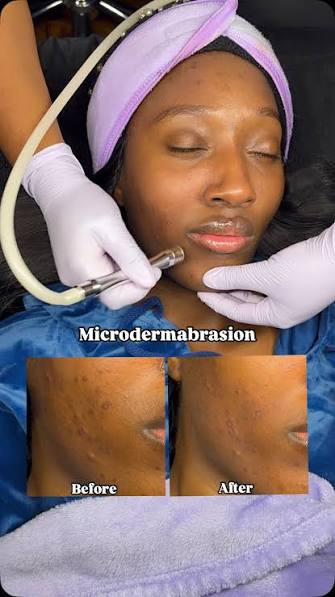 Microdermabrasion