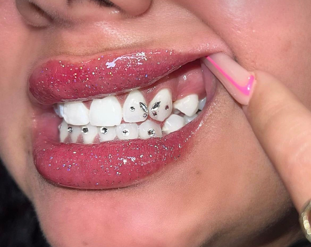 TOOTH GEM CONSULTATION 💎