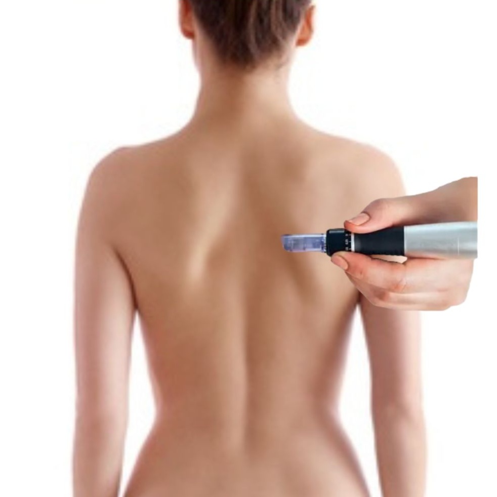 3 Back MicroNeedling Session at Skin Boutique North Carolina in Mooresville, NC