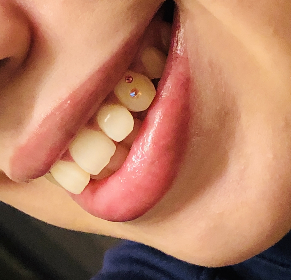 Tooth Gems