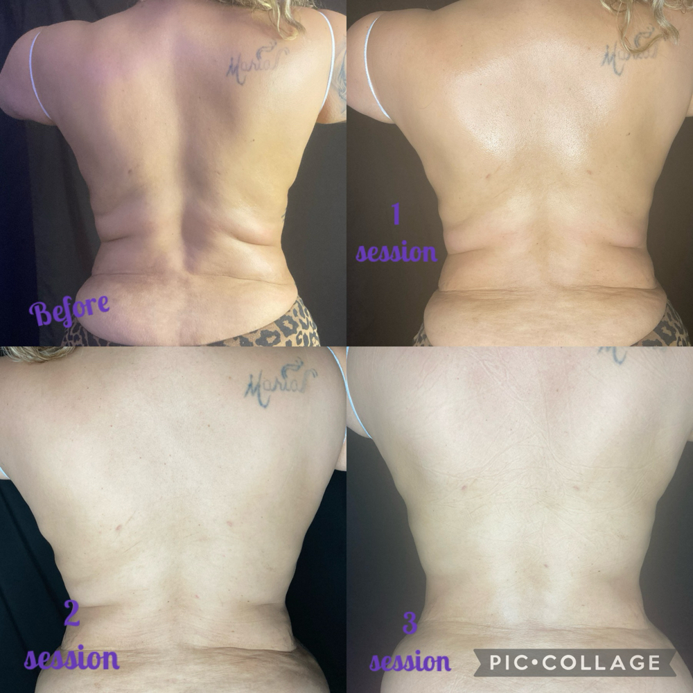 6 Skin Tightening Radio Frequency at Glo’s Beauty Creations