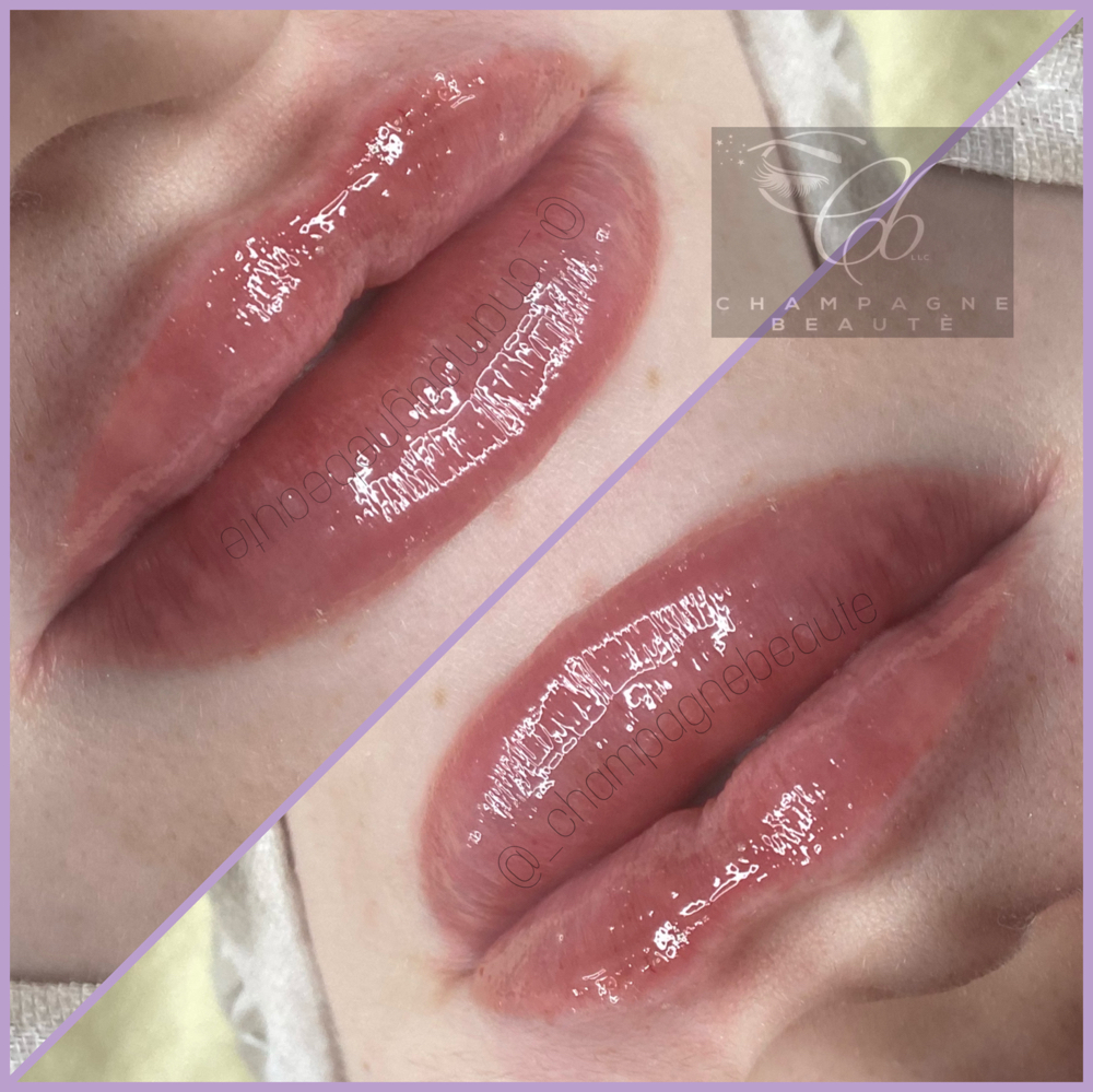 1 Syringe Lip Filler