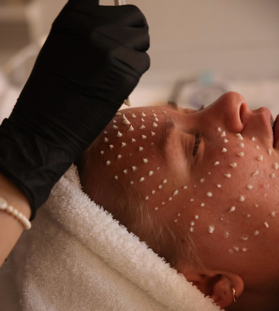Microneedling Liquido