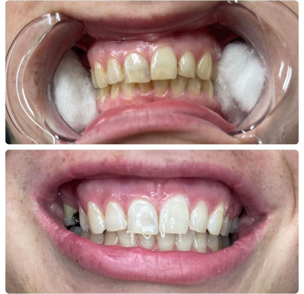 Teeth Whitening (40 Minutes) at Kara Genevieve Beauté in Millersville, MD